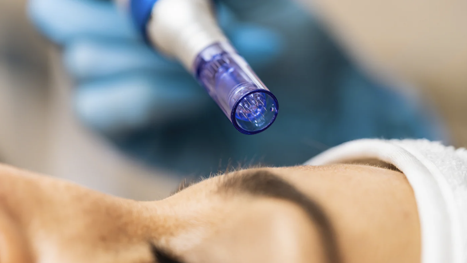 Microneedling treatment